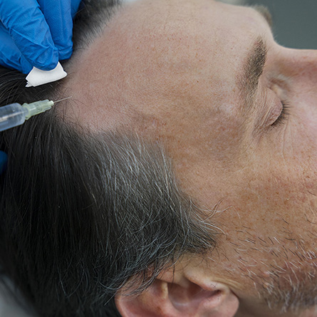 Man getting hair loss treatment